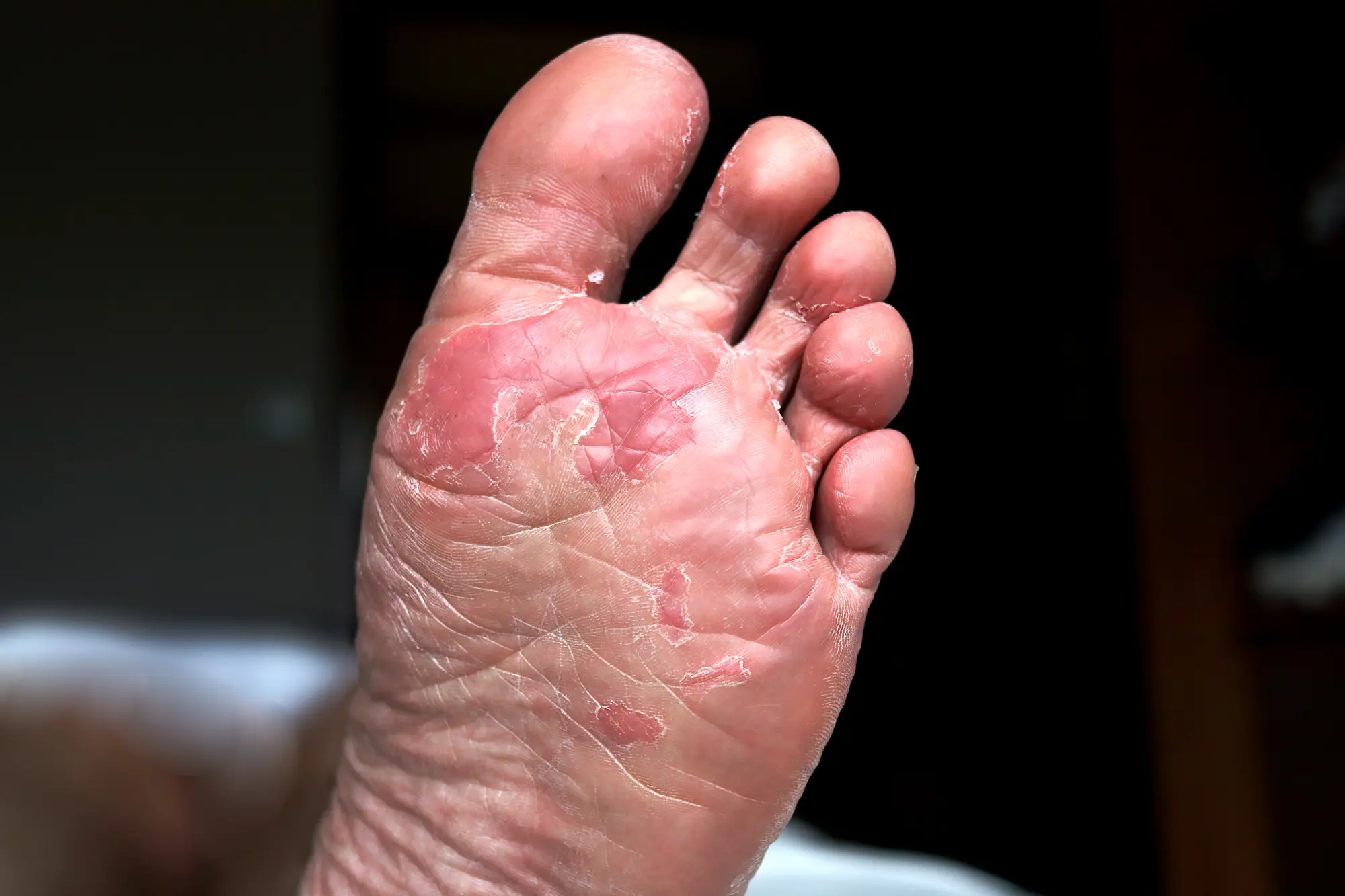 an example of a Fungal Infection treated at Biltmore Dermatology